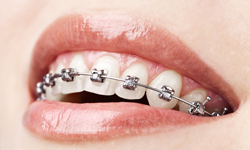 Does Everyone Who Wears Braces Need Elastics? - Soleil Orthodontics